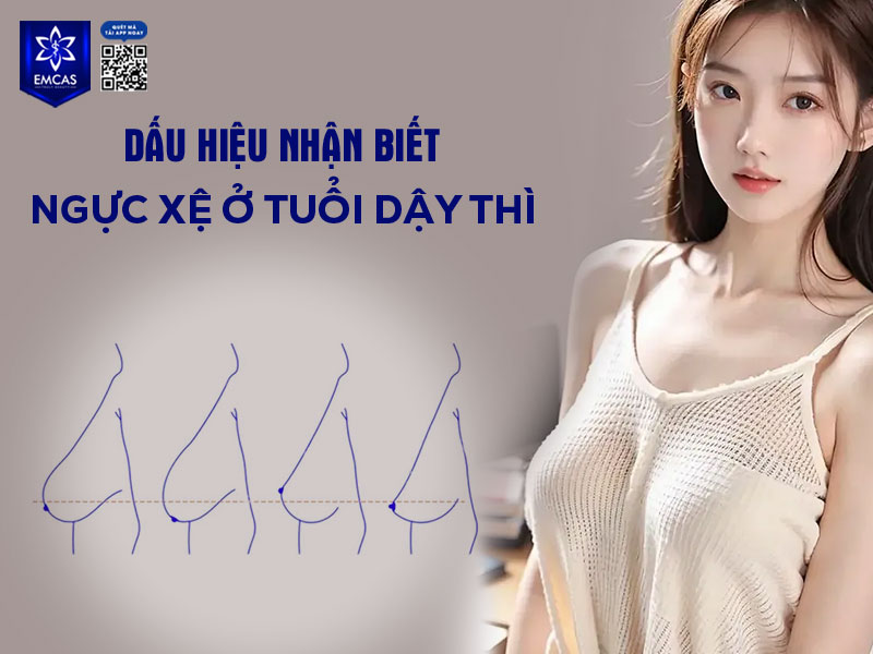 Để nhận biết ngực chảy xệ ở tuổi dậy thì, có thể dựa vào một số biểu hiện đặc trưng của vòng ngực trong quá trình phát triển.