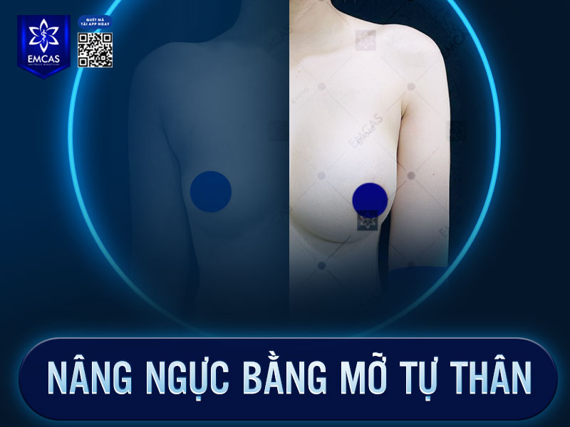 Cấy mỡ tự thân là phương pháp sử dụng chính mỡ của cơ thể (thường lấy từ bụng, đùi, lưng…) để cấy vào vùng ngực.