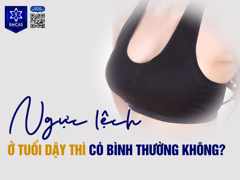 Ngực to nhỏ không đều ở tuổi dậy thì là hiện tượng khá phổ biến và được xem là hoàn toàn bình thường trong quá trình phát triển của cơ thể.