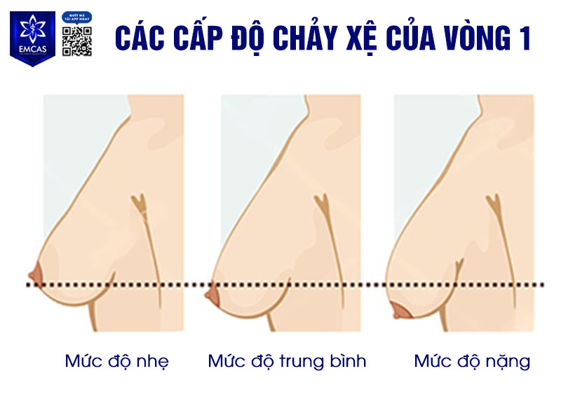 Tình trạng ngực xệ sau sinh có thể tự cải thiện một phần trong một số trường hợp nhẹ, nhưng rất khó để bầu ngực trở lại hoàn toàn như trước khi mang thai nếu da và mô nâng đỡ đã bị giãn nhiều.