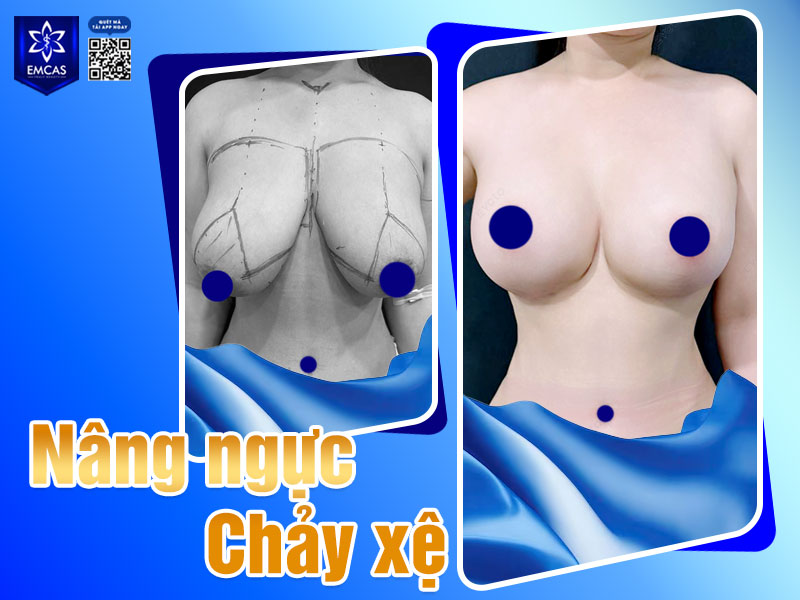 Treo sa trễ (mastopexy) là phương pháp tập trung xử lý tình trạng ngực chảy xệ sau sinh bằng cách loại bỏ da thừa và tái định vị quầng – núm vú lên vị trí cao hơn.