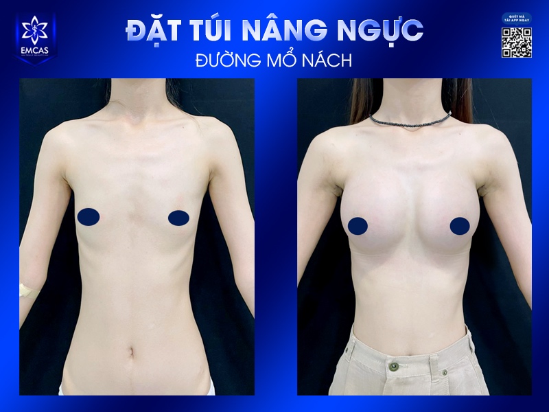Đặt túi nâng ngực là phương pháp nâng cấp vòng 1 phổ biến nhất hiện nay, sử dụng túi độn silicon đặt vào khoang ngực nhằm tăng kích thước và tạo hình vòng 1 rõ rệt.