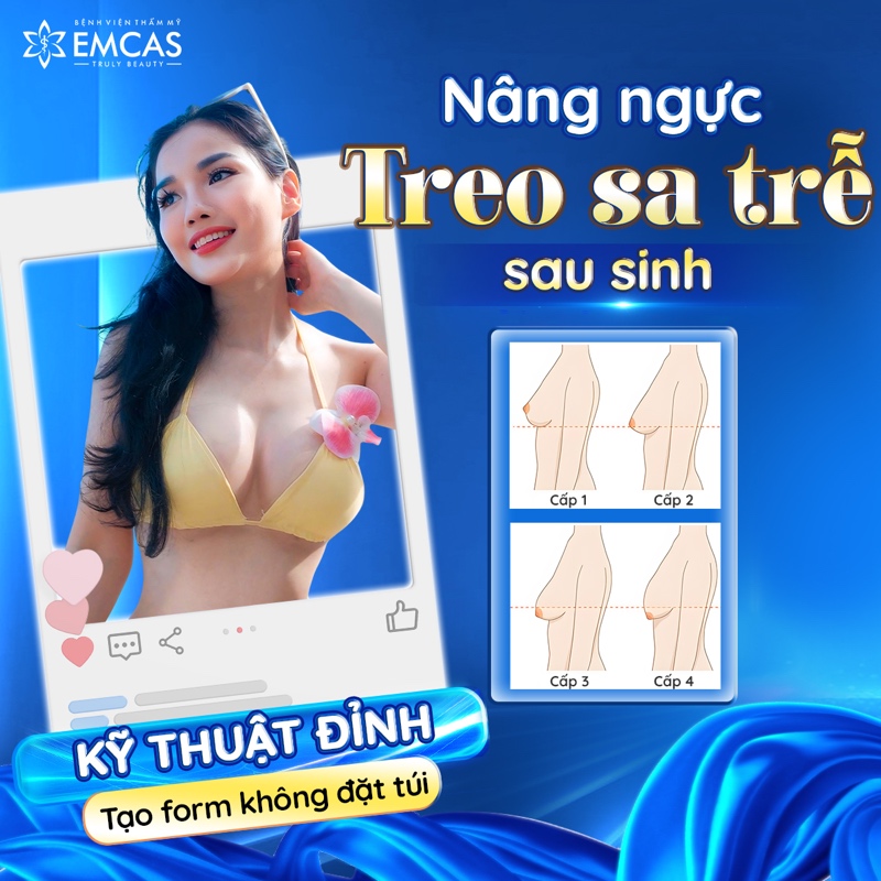 Treo sa trễ hay nâng ngực chảy xệ là giải pháp phẫu thuật nâng ngực dành cho trường hợp ngực chùng nhão, chảy xệ do sinh nở, lão hóa hoặc giảm cân.