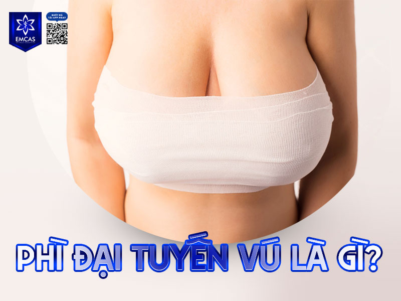 Phì đại tuyến vú là tình trạng mô tuyến phát triển quá mức, khiến kích thước vòng 1 tăng lên bất thường so với tỷ lệ cơ thể.