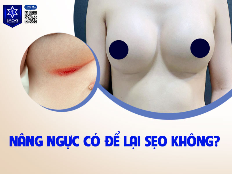 Nâng ngực để lại sẹo là điều không thể tránh khỏi vì bác sĩ cần phải tạo đường mổ để đưa túi độn vào bên trong. 