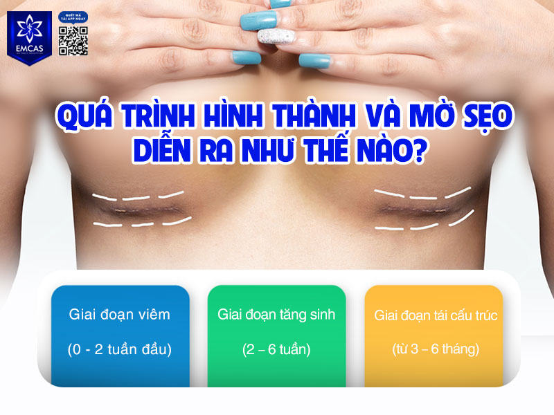 Sẹo nâng ngực hình thành và thay đổi theo 3 giai đoạn sinh học chính của quá trình tái tạo da