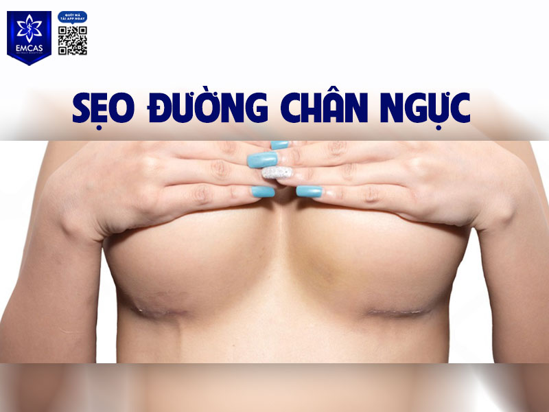 Nâng ngực đường chân ngực có sẹo nằm ở nếp gấp dưới bầu ngực (inframammary fold), dài khoảng 2–4 cm.