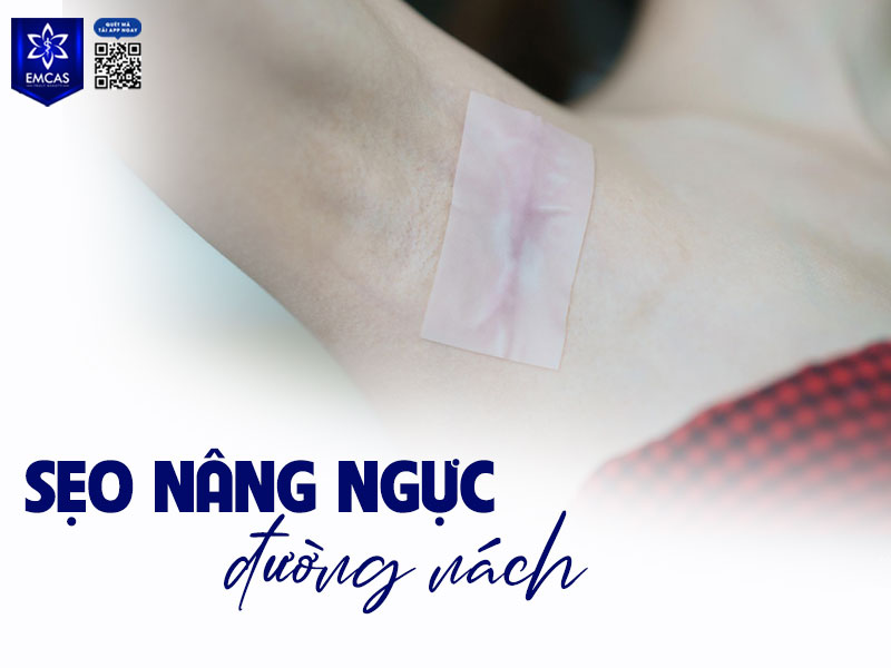 Sẹo nằm trong hõm nách, dài khoảng 2 – 3 cm, trùng với nếp gấp tự nhiên nên gần như không nhìn thấy khi đứng bình thường, chỉ lộ nhẹ khi giơ tay cao.