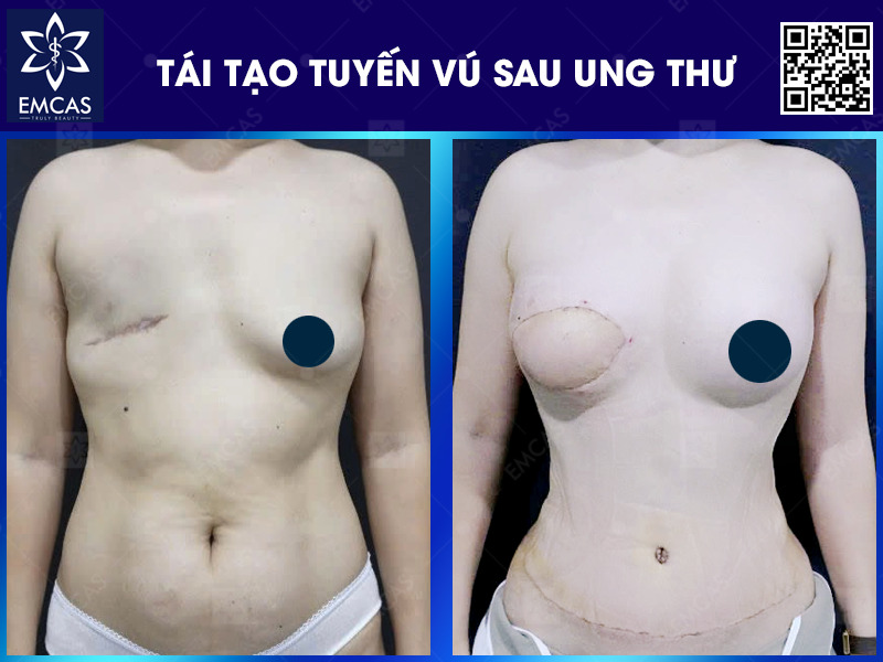 Để vết thương nhanh hồi phục, giảm thiểu khả năng xảy ra các biến chứng và mang lại kết thẩm mỹ lâu dài, bạn cần tuân thủ các hướng dẫn y khoa của bác sĩ.