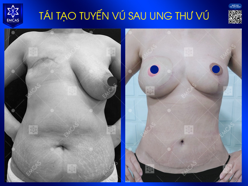 Việc quyết định thực hiện tái tạo tuyến vú sau ung thư còn phụ thuộc vào tình trạng bệnh lý, thể trạng tổng quát và lộ trình điều trị ung thư của từng người.