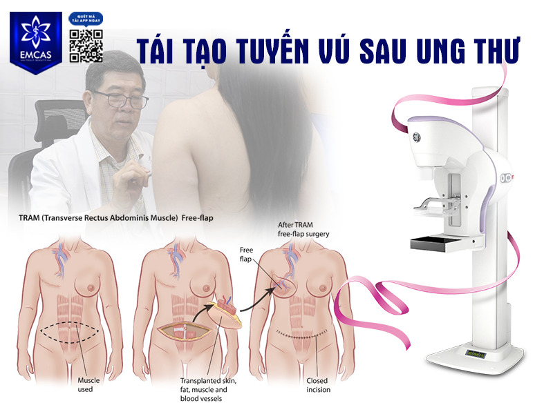 Tái tạo tuyến vú sau ung thư là phẫu thuật nhằm phục hồi hình dáng, kích thước và độ cân đối của bầu ngực cho những trường hợp đã cắt bỏ một phần hoặc toàn bộ tuyến vú trong quá trình điều trị ung thư.
