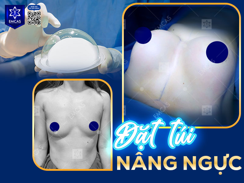 Nâng ngực bằng túi độn là phương pháp phổ biến giúp tăng size vòng 1 lên 90cm một cách nhanh chóng, an toàn và bền đẹp.