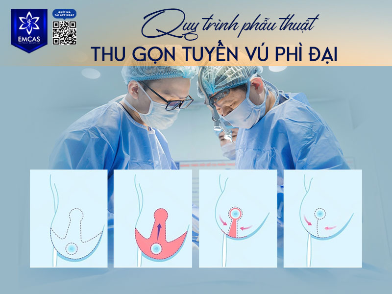 Tại Bệnh Viện Thẩm Mỹ EMCAS, quy trình phẫu thuật thu gọn tuyến vú phì đại được kiểm soát chặt chẽ nhằm đảm bảo an toàn, hiệu quả thẩm mỹ và khả năng hồi phục lâu dài.