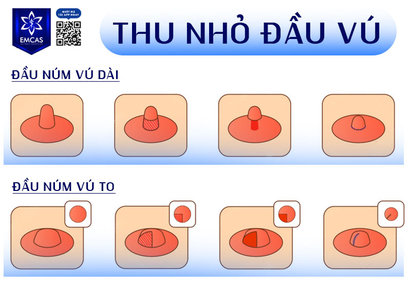 Tùy theo tình trạng đầu vú của bạn mà bác sĩ sẽ sử dụng kỹ thuật nào trong quá trình thực hiện.