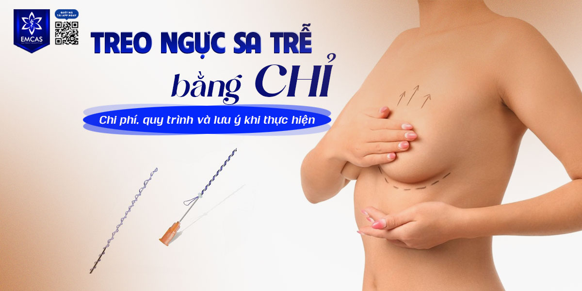 Treo ngực sa trễ bằng chỉ: Chi phí, quy trình và lưu ý khi thực hiện