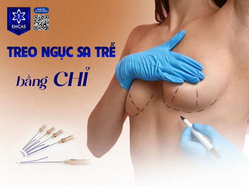Treo ngực sa trễ bằng chỉ là phương pháp sử dụng các sợi chỉ sinh học chuyên dụng đưa vào mô ngực để tạo sự nâng đỡ bên trong, giúp cải thiện tình trạng chảy xệ ở mức độ nhẹ
