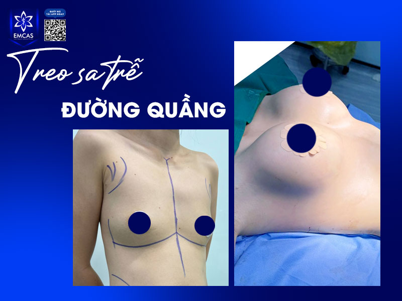 Nâng ngực sa trễ đường quầng là phẫu thuật thẩm mỹ cần được thực hiện ở cơ sở thẩm mỹ uy tín bởi các bác sĩ có chuyên môn và kinh nghiệm nhằm đảm bảo an toàn và kết quả thẩm mỹ lâu dài. 