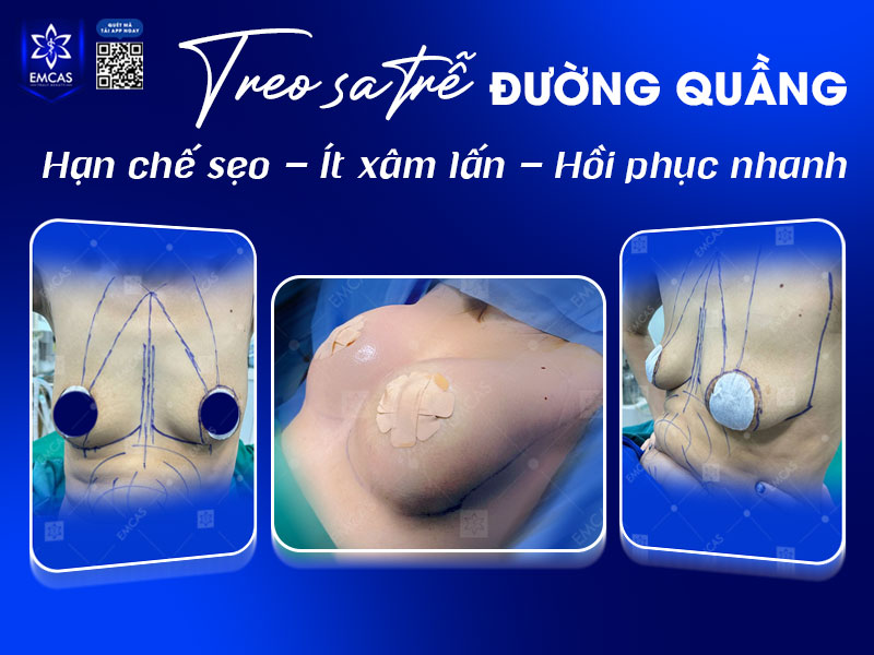 Nâng ngực sa trễ đường quầng được nhiều người lựa chọn nhờ sở hữu một số ưu điểm nổi bật.