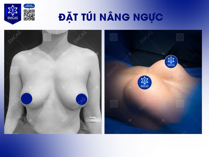 Phẫu thuật nâng ngực giúp cải thiện vòng 1 nhanh chóng, tạo hình bầu ngực đầy đặn và cân đối với cơ thể.