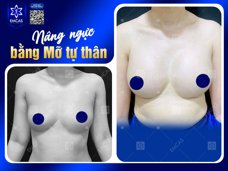 Nâng ngực không phẫu thuật bằng mỡ tự thân sử dụng chính lượng mỡ dư thừa từ các vùng như bụng, đùi hoặc eo của cơ thể, sau đó lọc tách và cấy vào vùng ngực để tăng thể tích bầu ngực.