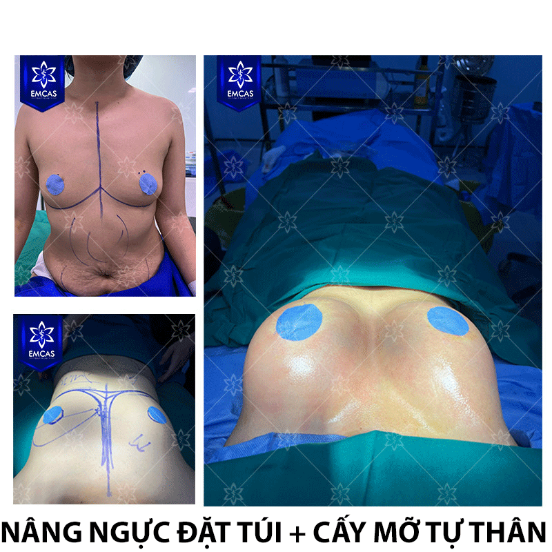 Lượng Mỡ Tự Thân - Chìa Khóa Nâng Ngực Tự Nhiên