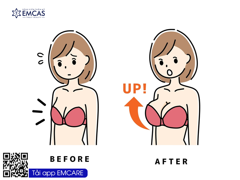 Nâng Ngực Không Phẫu Thuật Là Gì?