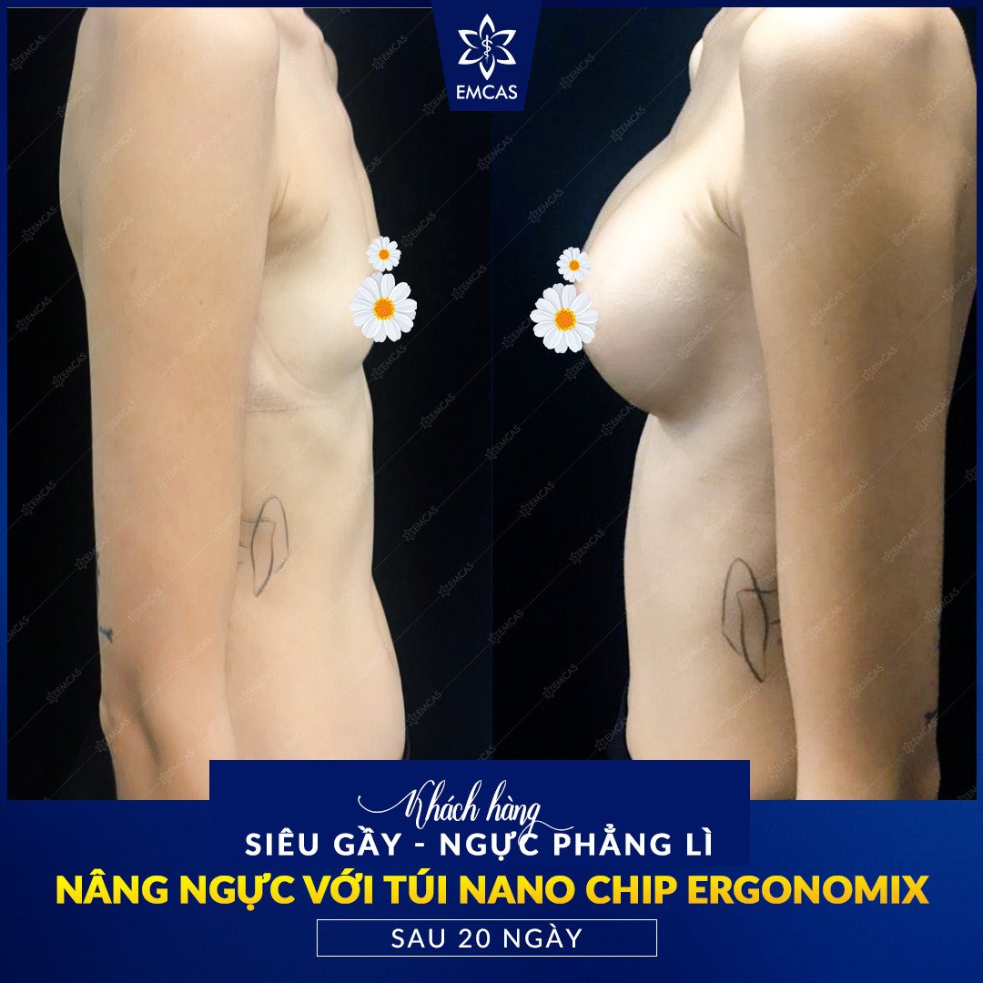 What is nano chip breast augmentation, nano-chip breast augmentation is good, how long is nano chip breast augmentation, nano chip capsules, what are nano chip capsules, good nano-chip breast enhancement, capsule Nano chip is covered