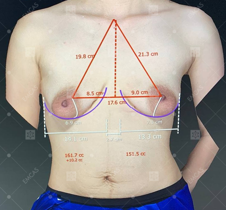 NÂNG NGỰC SA TRỄ ĐỘ 1 - 4