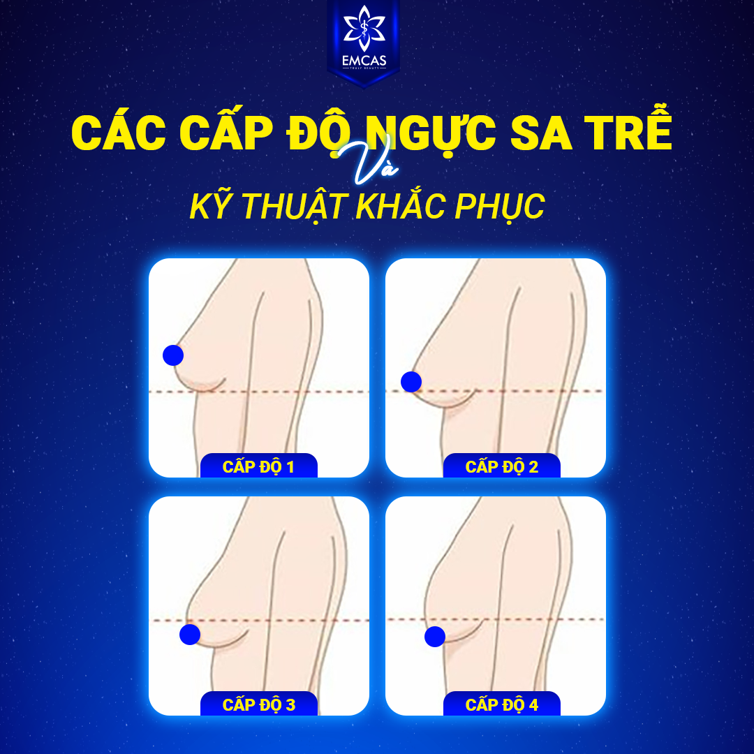 NÂNG NGỰC SA TRẾ ĐỘ 1-4