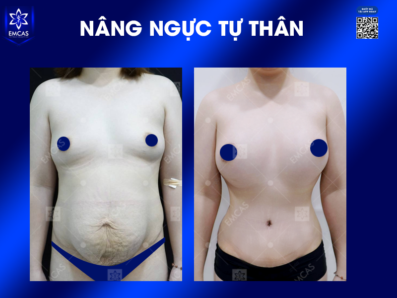 Các Bước Thực Hiện Phẫu Thuật Bóc Tách Bao Xơ