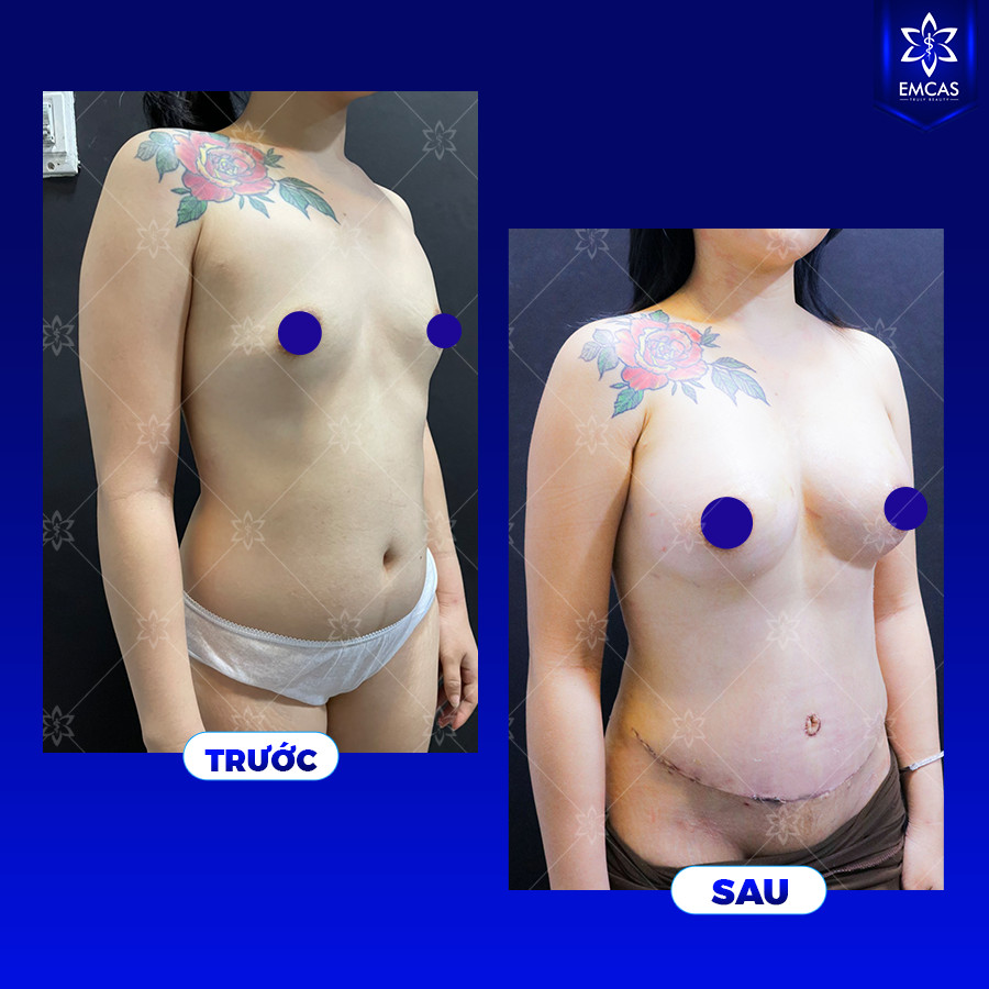 NÂNG NGỰC TỰ THÂN