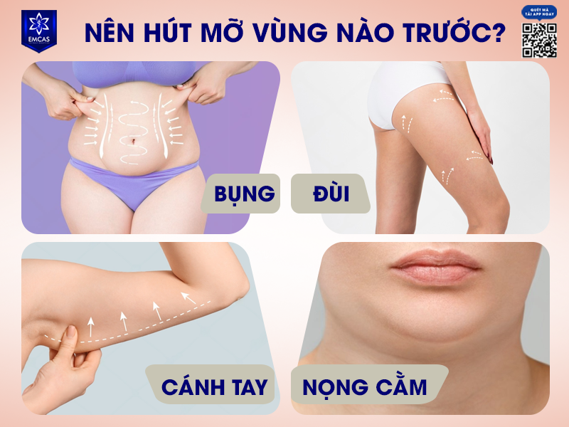 Nên Hút Mỡ Bụng, Đùi, Cánh Tay Hay Nọng Cằm Trước?