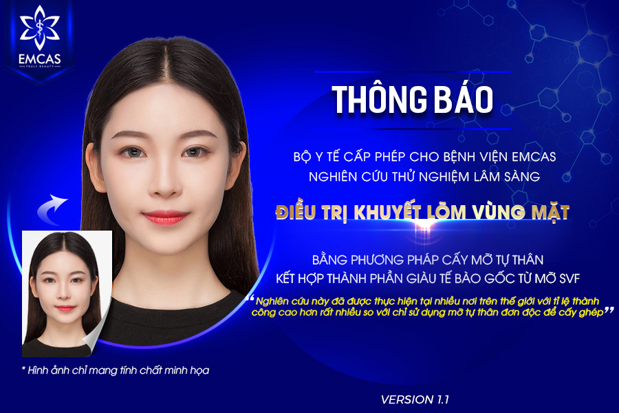 Thông Báo: Bộ Y Tế Cấp Phép Cho BV EMCAS Nghiên Cứu Thử Nghiệm Lâm Sàng Điều Trị Khuyết Lõm Vùng Mặt Bằng Phương Pháp Cấy Mỡ Tự Thân Kết Hợp Thành Phần Giàu Tế Bào Gốc Từ Mỡ SVF