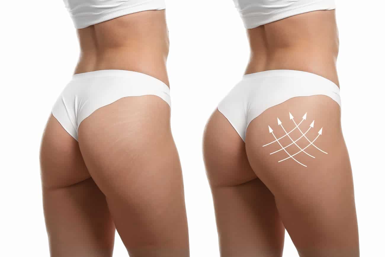 Mông Xệ Là Như Thế Nào? Cách Nâng Mông Xệ Hiệu Quả Nhất