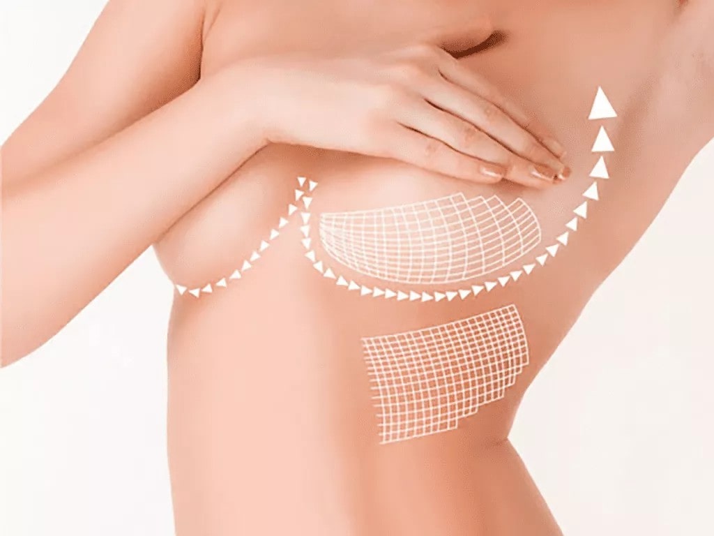 Nâng Ngực Bằng Mỡ Tự Thân Có Ảnh Hưởng Gì Không?