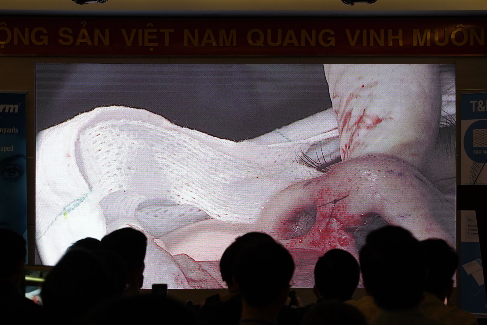 Bác Sĩ BVTM EMCAS Tham Gia Khóa Học CME Phẫu Thuật Tạo Hình Thẩm Mỹ Mũi Cấu Trúc Nâng Cao 2022
