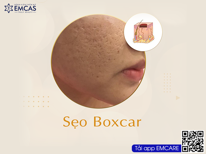 Điều trị sẹo lõm
