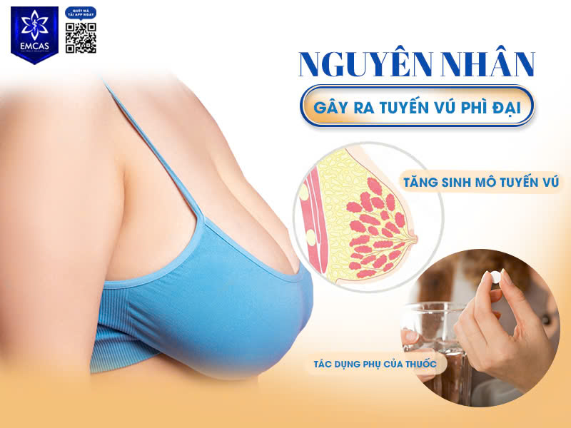 Nguyên Nhân Và Cách Điều Trị Tuyến Vú Phì Đại Hiệu Quả