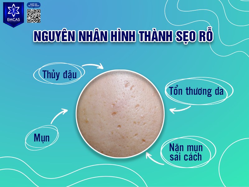 Sẹo Rỗ Là Gì? Nguyên Nhân Hình Thành Sẹo Rỗ?