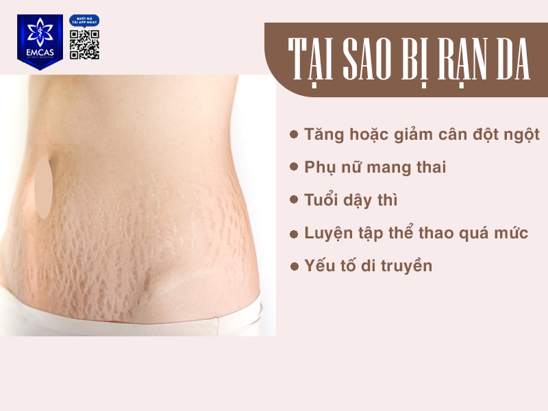 Rạn Da Có Ảnh Hưởng Gì Không?