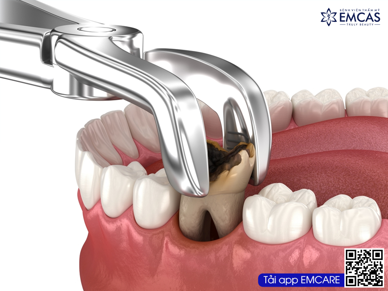 NHỔ RĂNG KHÔNG ĐAU S-TEETH