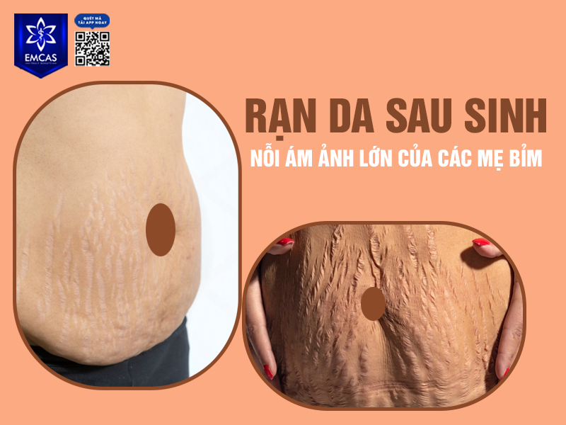 Phương Pháp Phục Hồi Làn Da Bị Rạn Sau Sinh
