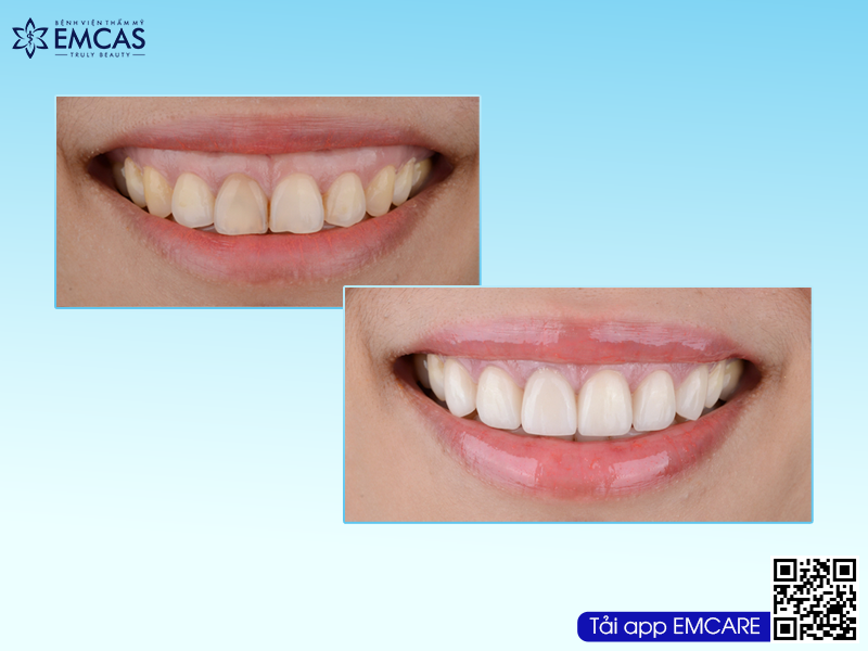 CHỮA CƯỜI HỞ LỢI – GUMMY SMILE