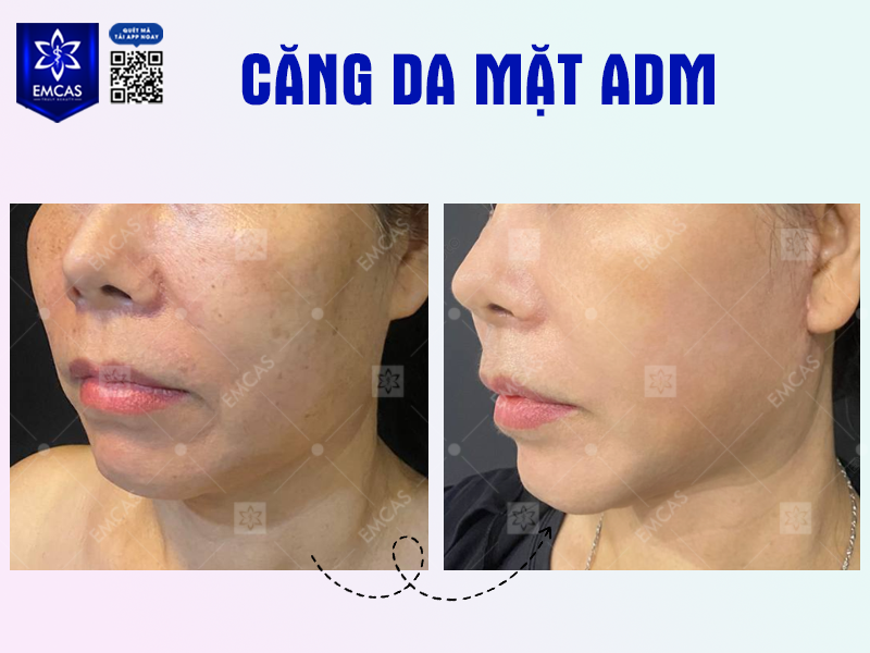 Căng Da Mặt ADM Là Gì? Tất Tần Tật Những Điều Bạn Cần Biết