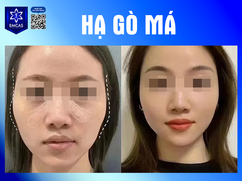 Gò Má Cao Có Xấu Không? Khi Nào Cần Hạ Gò Má?
