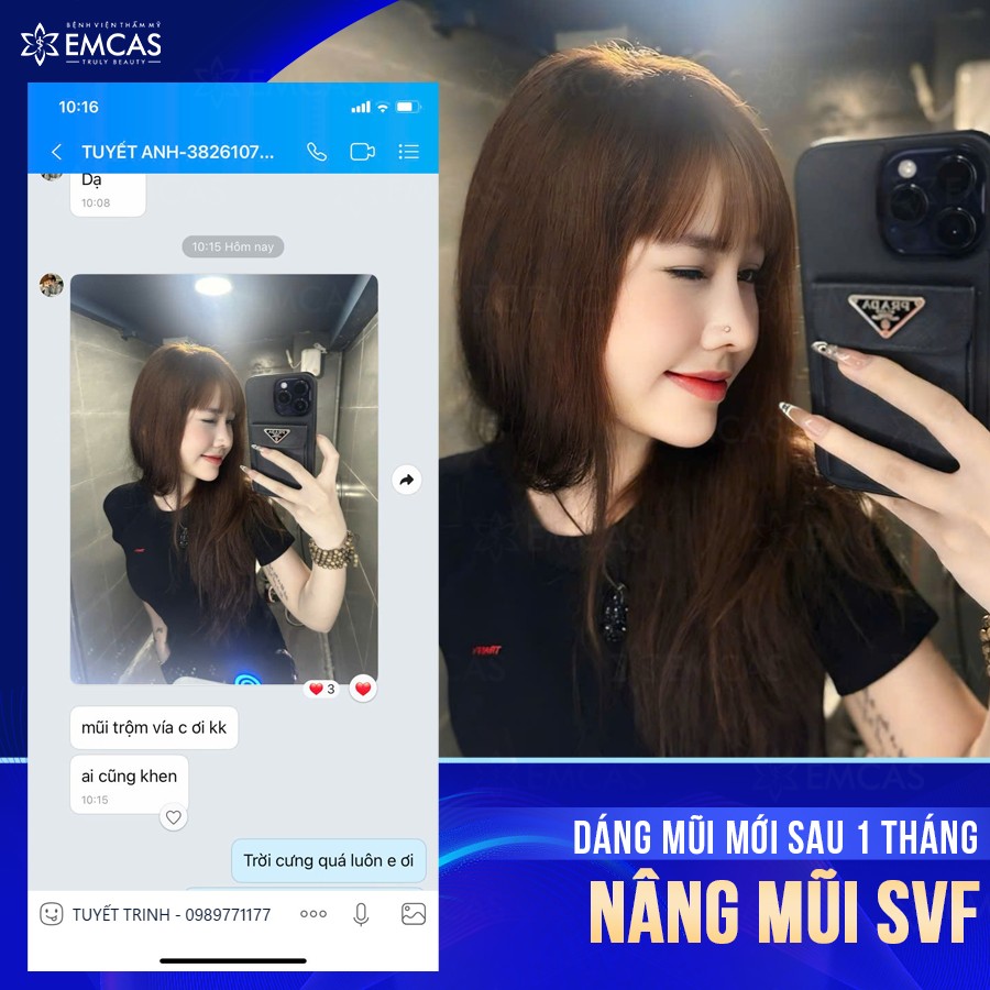 Nâng Mũi SVF Là Gì? Có Ưu Điểm Gì So Với Phương Pháp Khác?