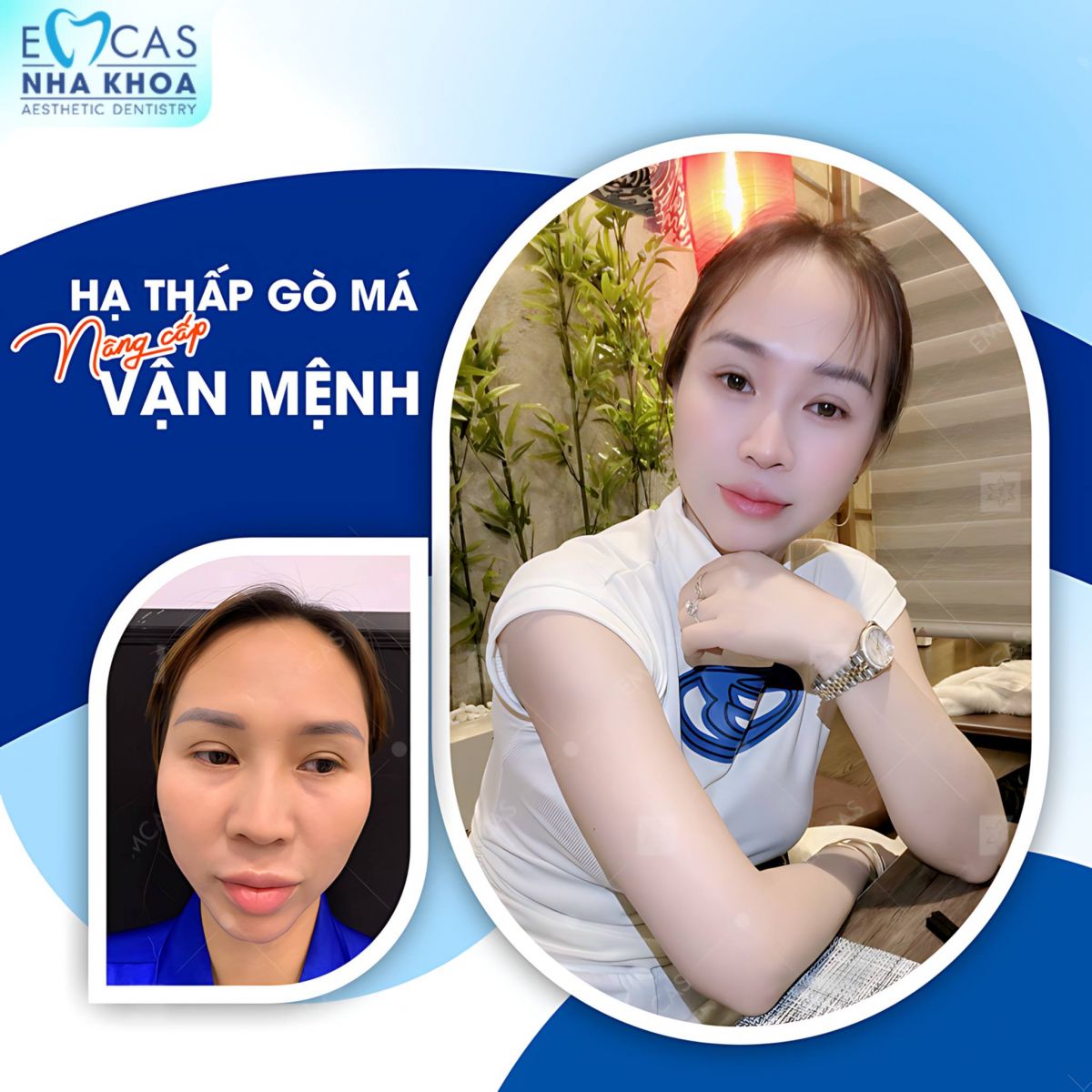 Hạ Gò Má Có Duy Trì Vĩnh Viễn Không?