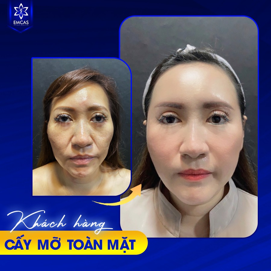 Quy Trình Làm Đầy Vùng Mặt Bằng Mỡ Tự Thân