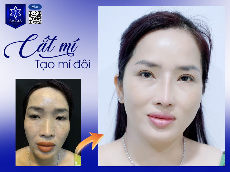 Cắt Mí Mắt Có Đau Không? Những Lưu Ý Quan Trọng Sau Phẫu Thuật