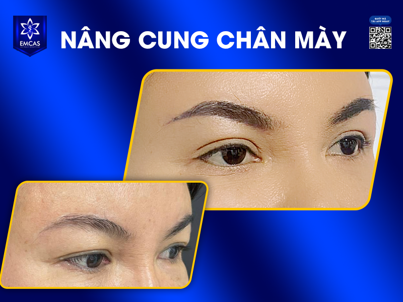 Nâng Cung Chân Mày Là Gì?